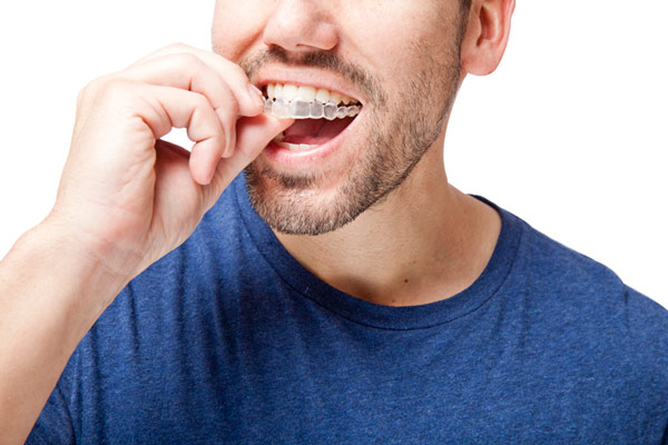 Man wearing Invisalign clear aligner