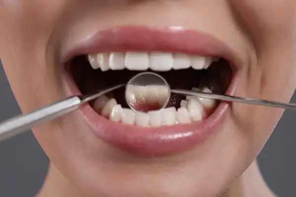 Dental tools inspecting a patient's teeth and gums during a periodontal checkup for signs of gum disease.